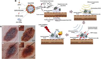 Recent Progress in Nanomedicine for Melanoma Theranostics With Emphasis on Combination Therapy